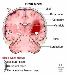 14480 brain bleed hemorrhage intracranial hemorrhage