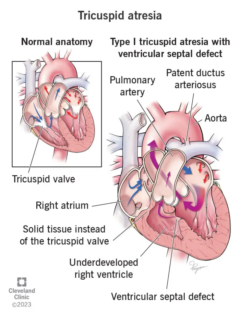 14789 tricuspid atresia