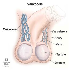 15239 varicocele