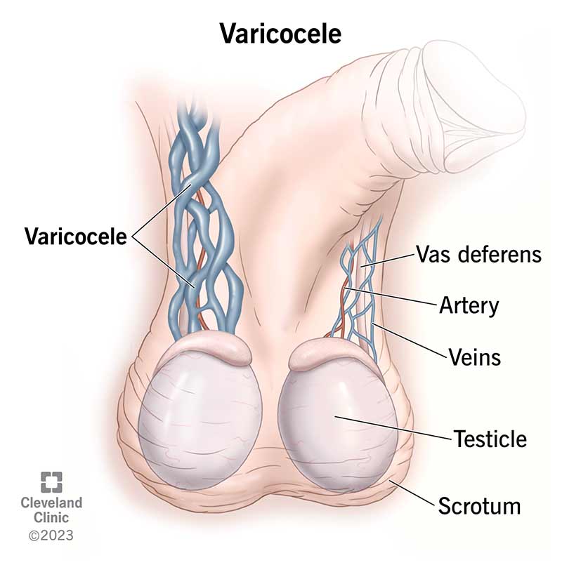 15239 varicocele