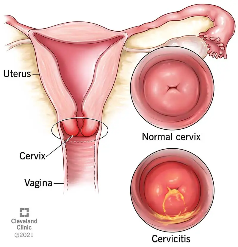 15360 cervicitis