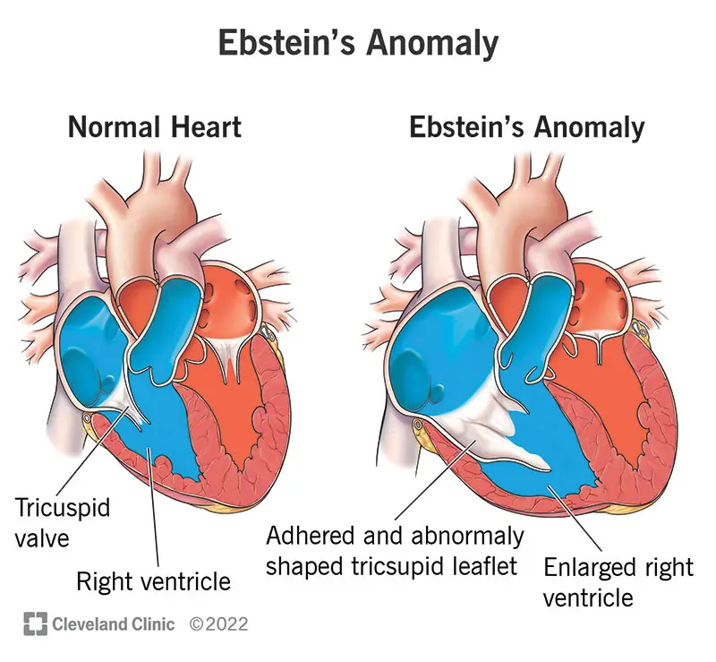 16946 ebsteins anomaly