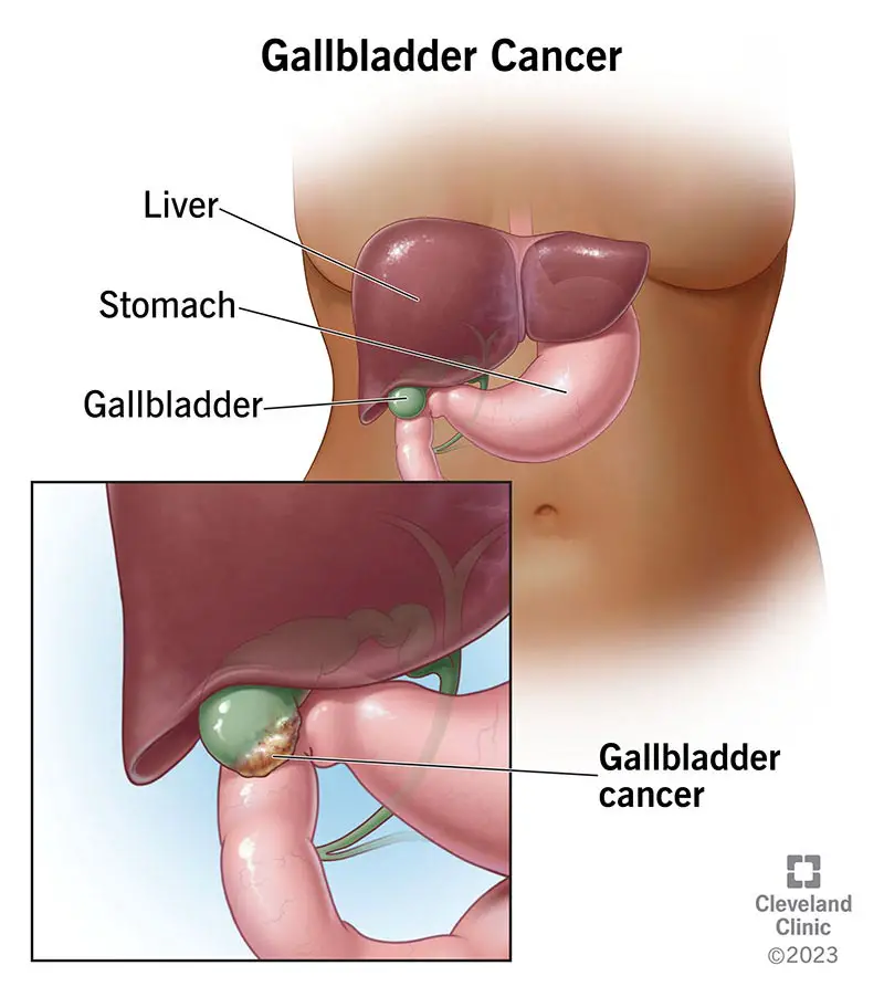 17013 gallbladder cancer