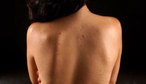 1709252717 22756 back acne