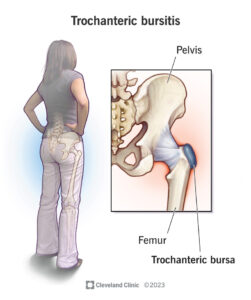 1709385261 4964 trochanteric bursitis