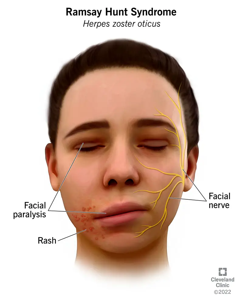 1709472081 6093 ramsay hunt syndrome