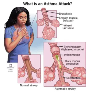 1709522303 6424 asthma