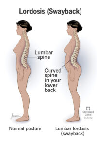 1709535979 23908 lordosis