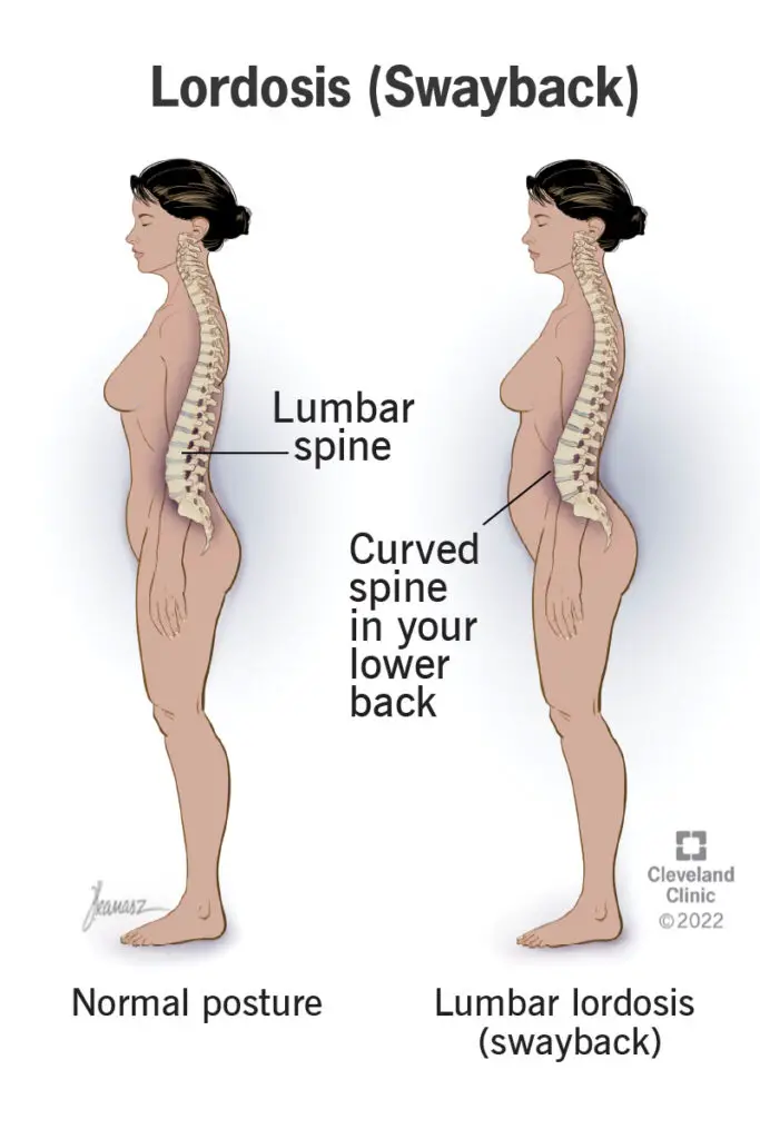 1709535979 23908 lordosis