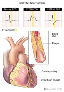 1709549668 22233 nstemi heart attack illustration