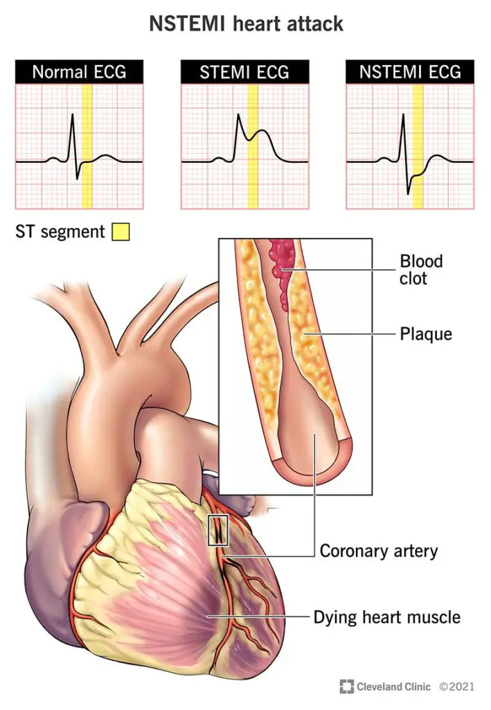 1709549668 22233 nstemi heart attack illustration