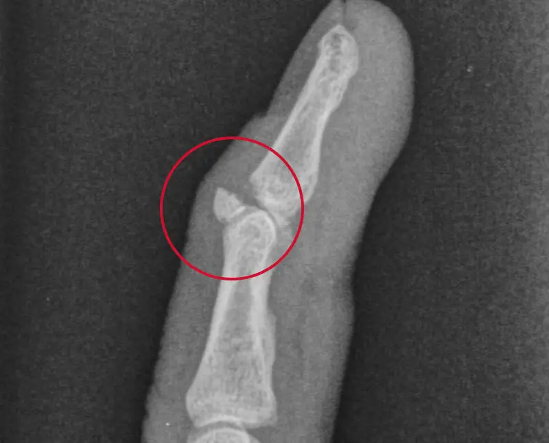 1709563401 21802 avulsion fracture