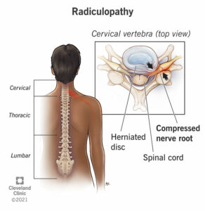 1709568022 22564 radiculopathy