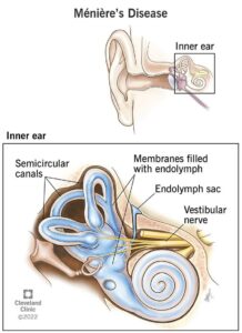 1709577136 15167 menieres disease