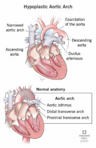 1709586256 24920 hypoplastic aortic arch