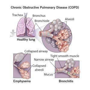 1709668520 8709 copd