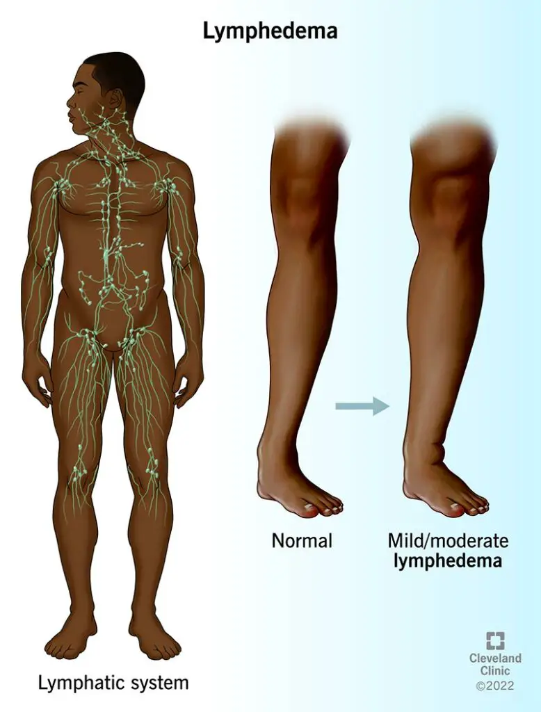 1709691316 8353 lymphedema