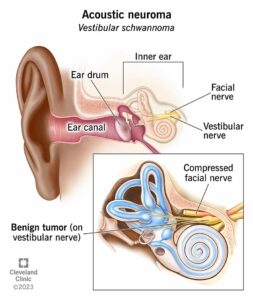 1709695875 16400 acoustic neuroma