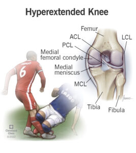 1709732356 22481 hyperextended knee