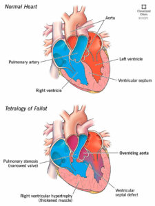 1709809996 23347 overriding aorta