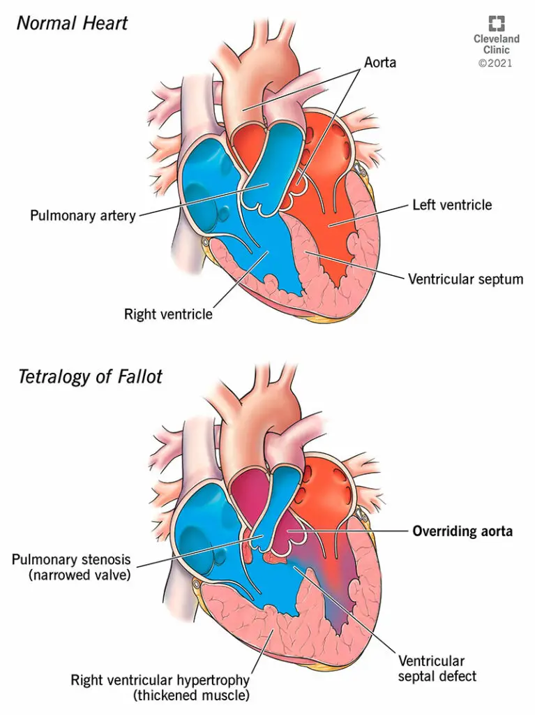 1709809996 23347 overriding aorta