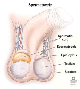 1709869516 17492 spermatocele