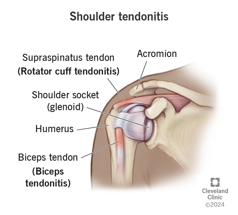 1709878755 shoulder tendonitis