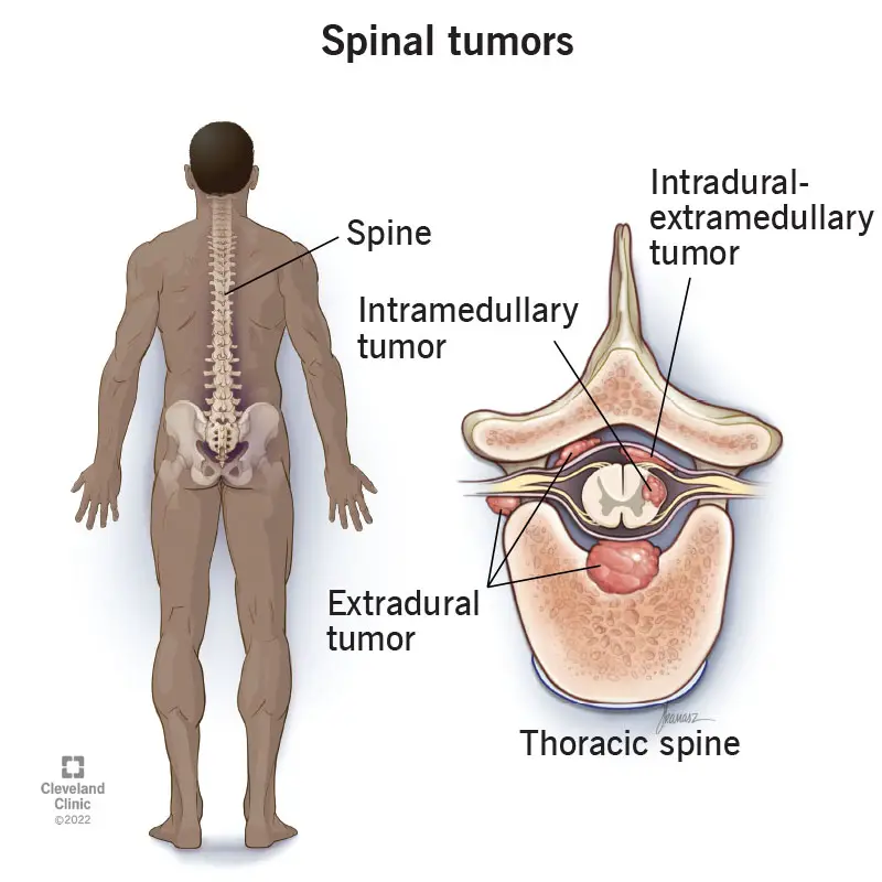 1710002057 17500 spinal tumors