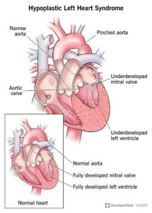 1710070637 12214 hypoplastic left heart syndrome