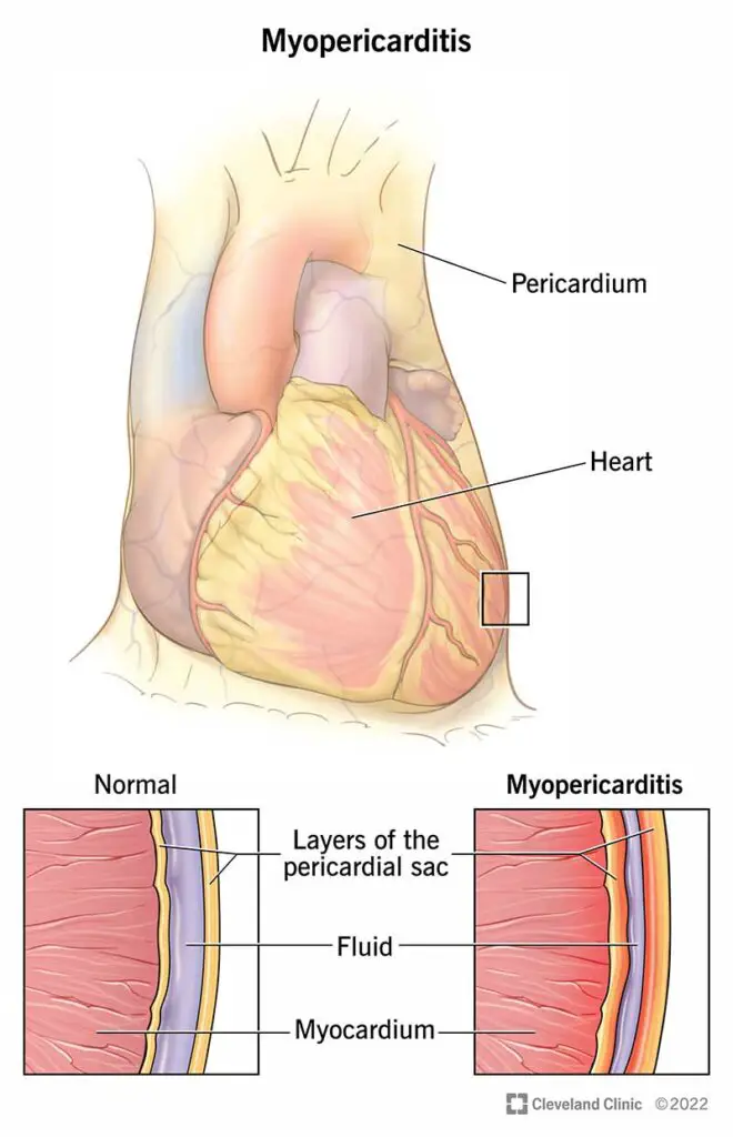 1710202996 24579 myopericarditis