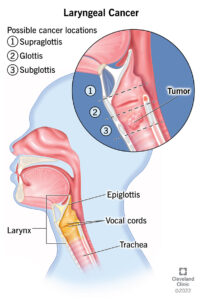 1710280517 16611 laryngeal cancer