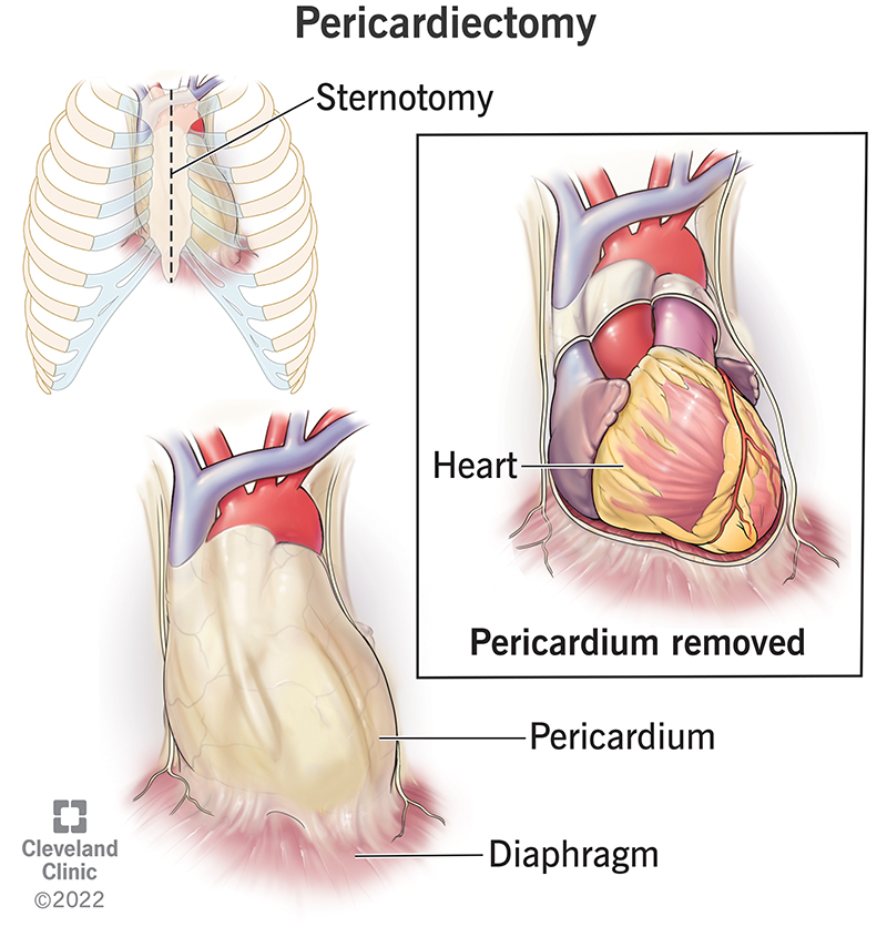 Perikardiektomija noņem membrānas maisiņu ap sirdi.