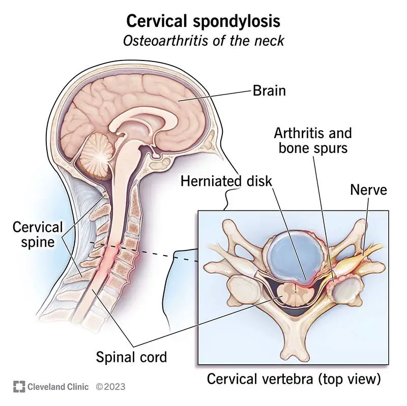 17685 cervical spondylosis