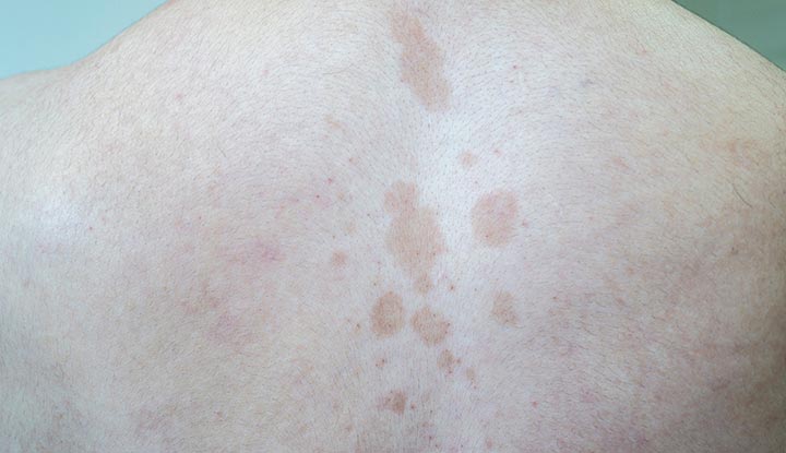 Tinea versicolor cilvēka muguras augšdaļas vidū.