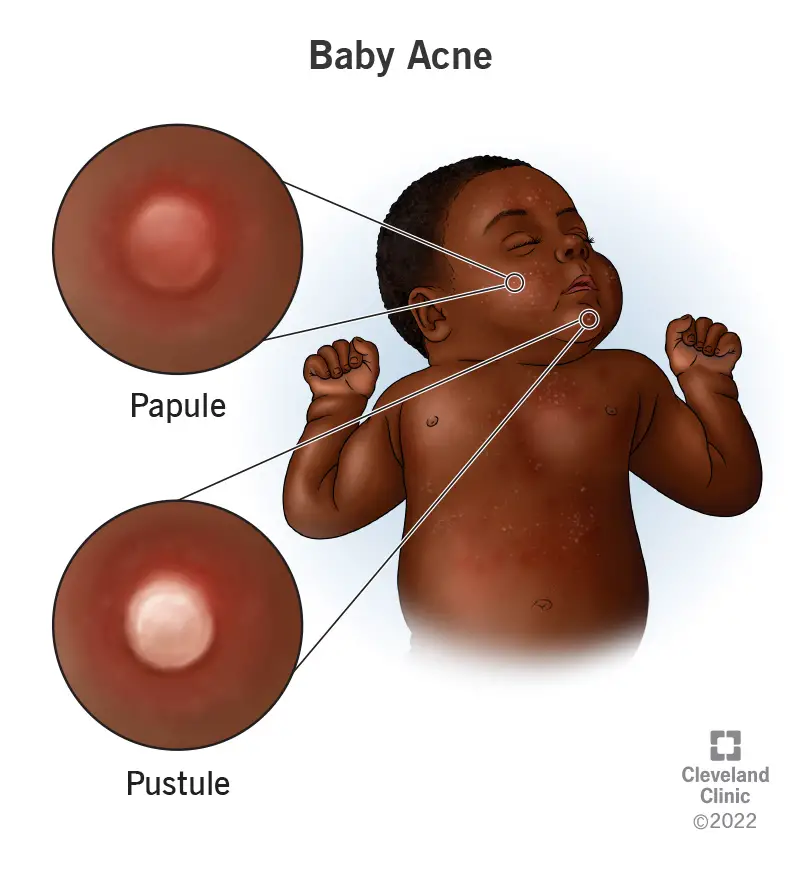 17822 baby acne