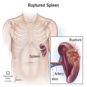 17953 ruptured spleen