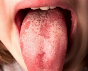 21177 geographic tongue