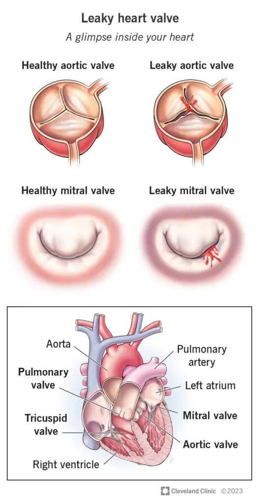 21484 Leaky Heart Valve.ashx