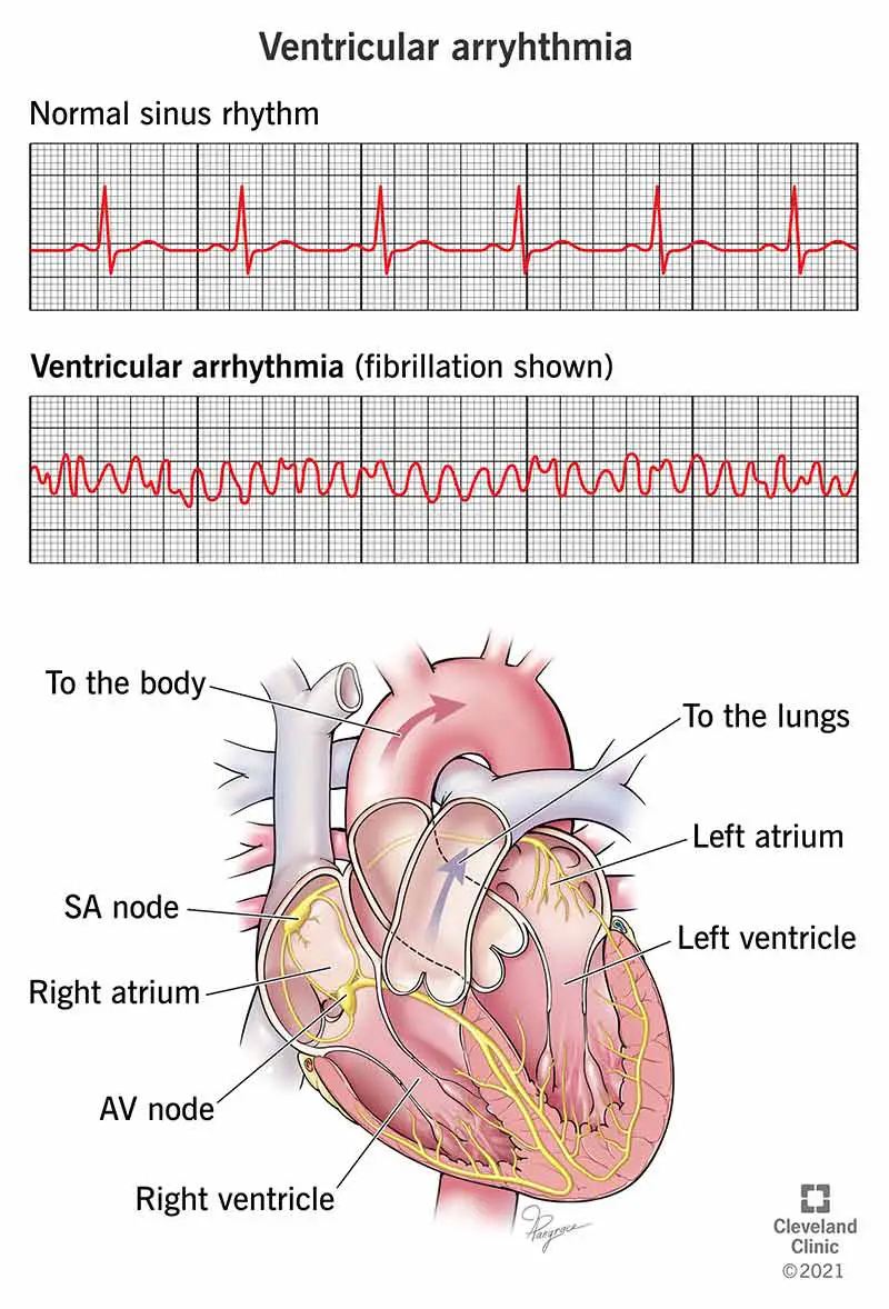 EKG, kas parāda ventrikulāru aritmiju.