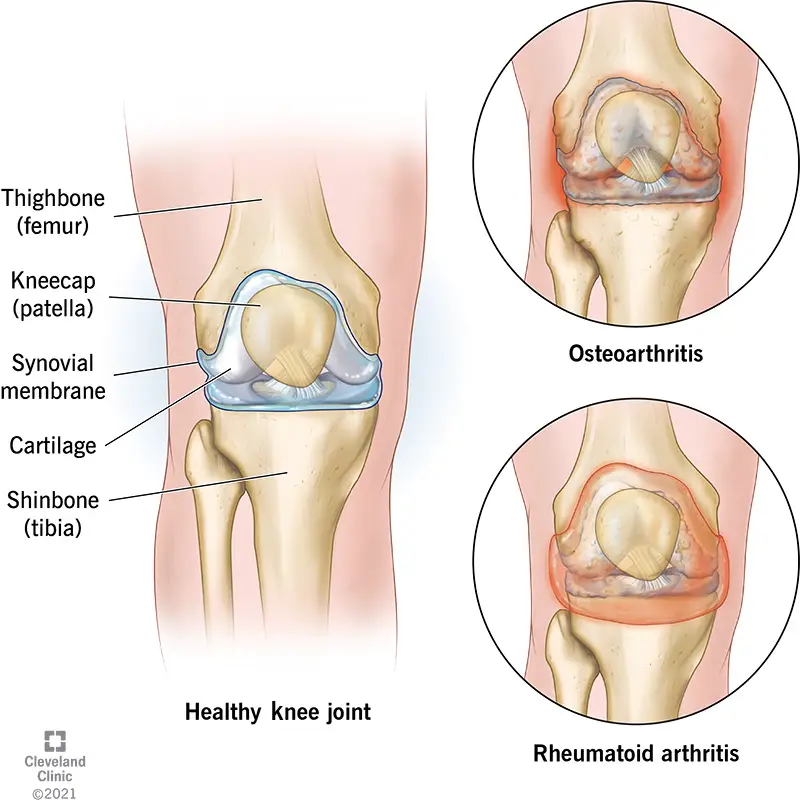 21978 arthritis of the knee