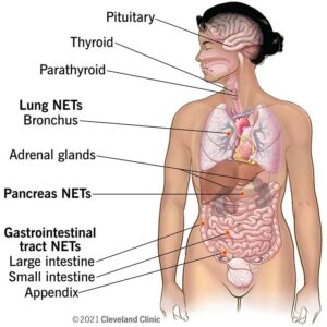 22006 Neuroendocrine tumors