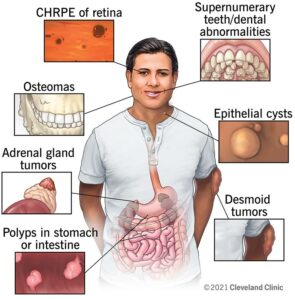 22013 gardner syndrome