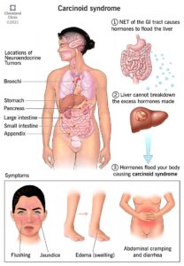 22103 carcinoid syndrome