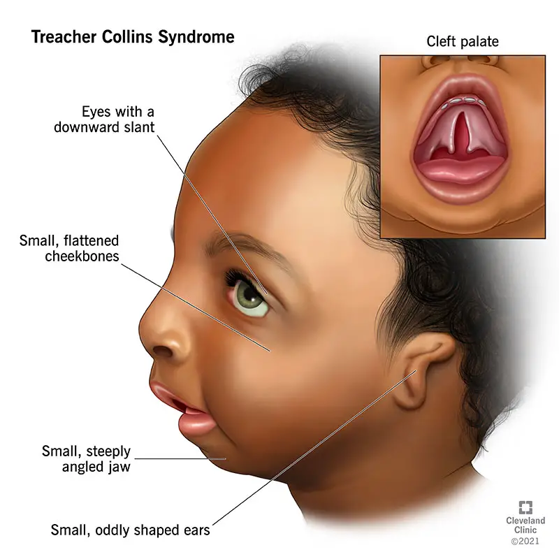 22149 treacher collins syndrome