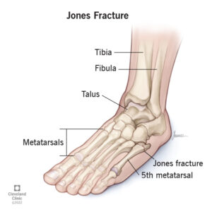 22239 jones fracture