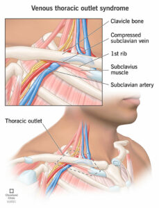 22317 venous thoracic outlet syndrome