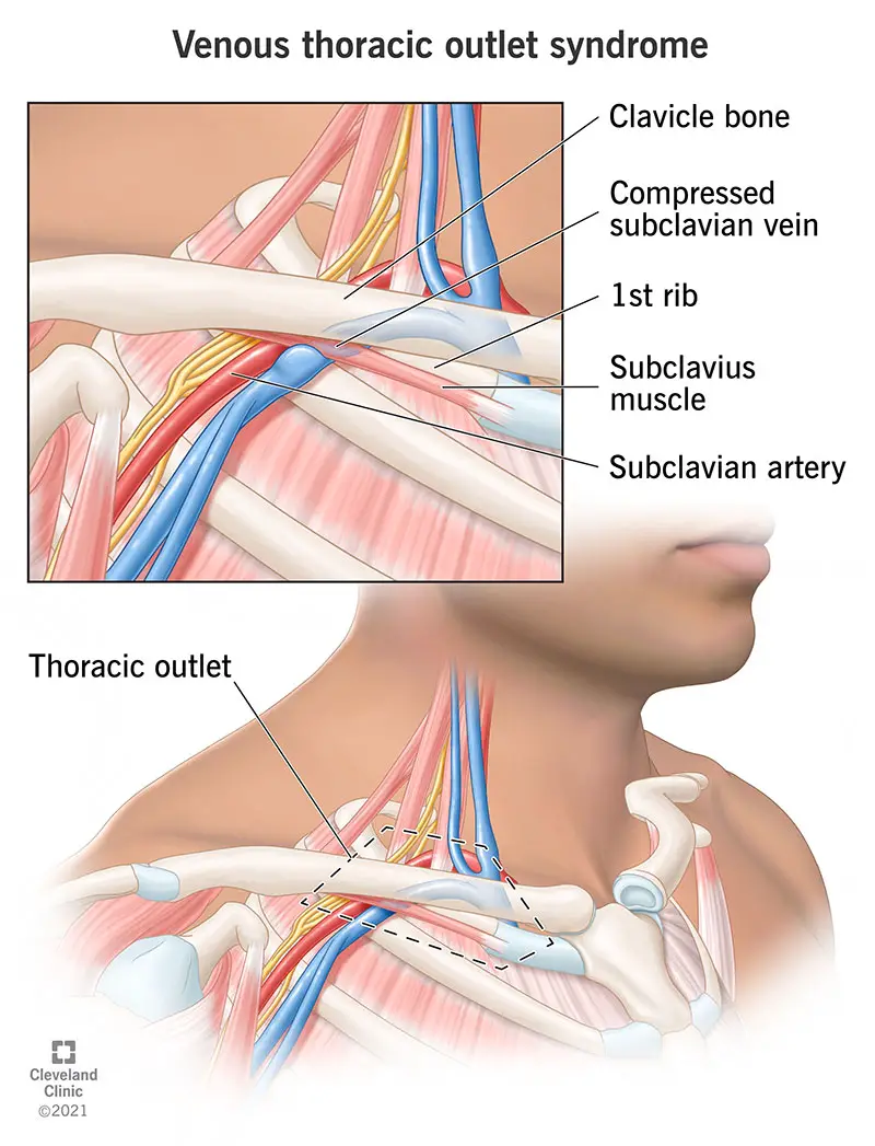 Vēnu un artēriju saspiešana starp apkakles kaulu un pirmo ribu, izraisot venozās krūšu kurvja izejas sindromu.