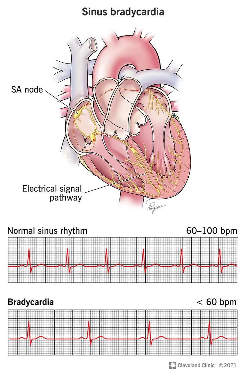 EKG un sinusa bradikardijas ilustrācija.