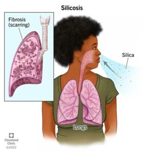 22622 silicosis