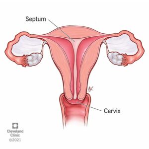 22809 septate uterus